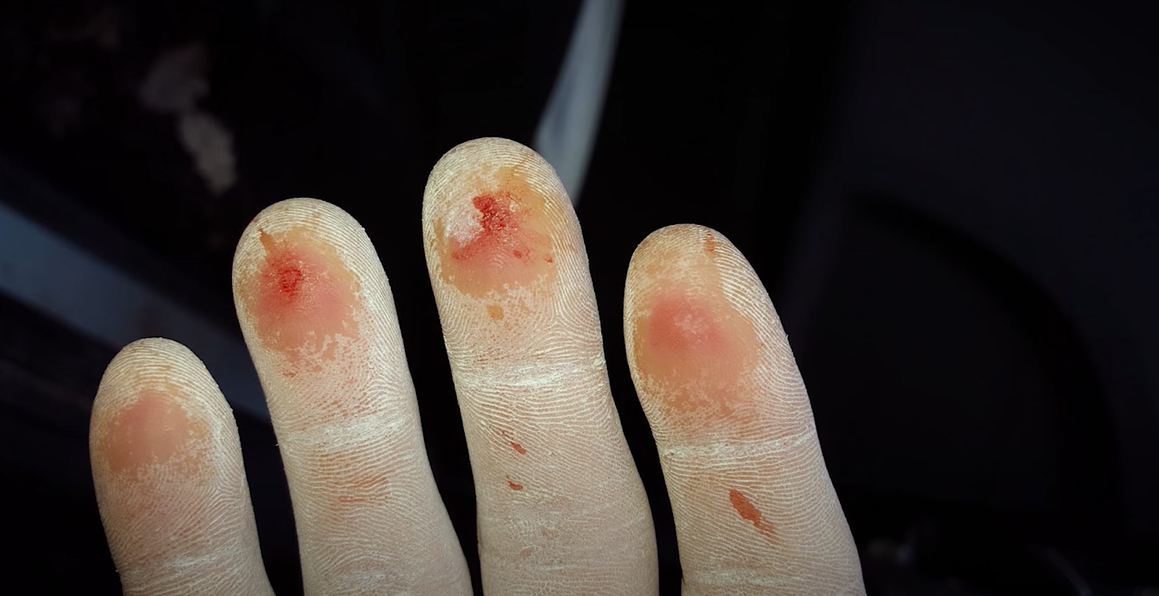 damaged fingers from climbing damaged fingers from climbing